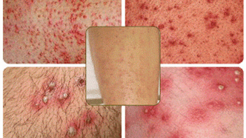 Viêm nang lông: Nguyên nhân, triệu chứng & cách điều trị hiệu quả